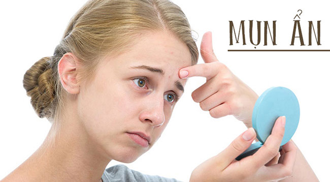 mun-an-la-gi-0 mụn ẩn là gì