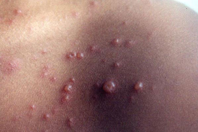 not-thuy-dau-chuyen-sang-mau-trang-duc-2 Bội nhiễm nốt thủy đậu là gì có nguy hiểm không