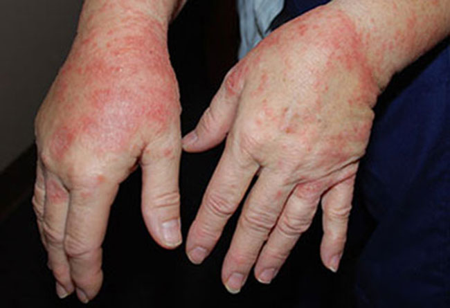 nuoc-rua-tay-kho-lam-di-ung-da-tay nuoc-rua-tay-kho-lam-di-ung-da-tay