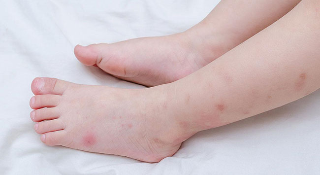 Xử lý vết muỗi hay côn trùng đốt